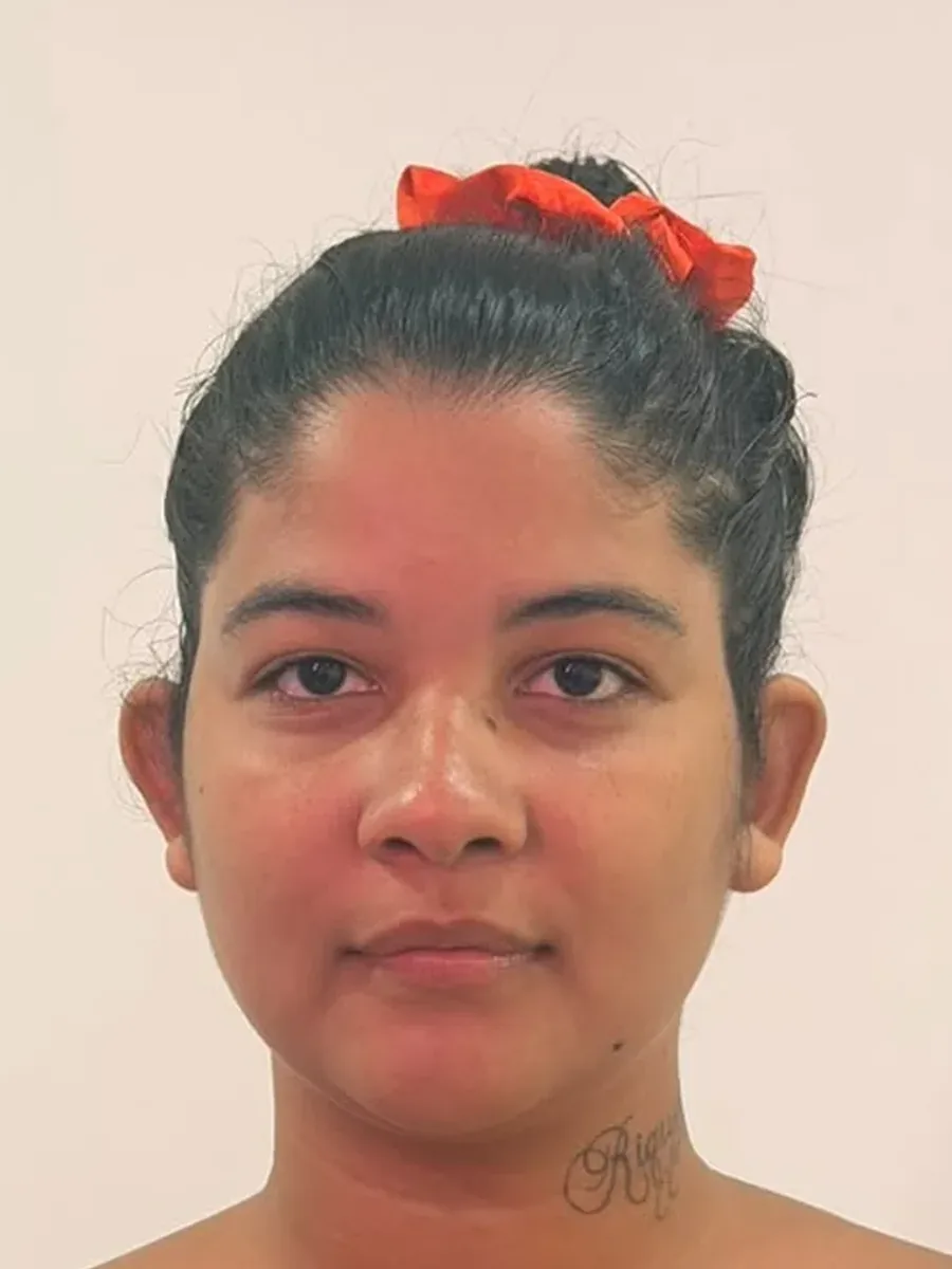 Antes da otomodelação: orelhas de abano projetadas em paciente feminina, vista frontal, Luquini Clinic no Rio de Janeiro