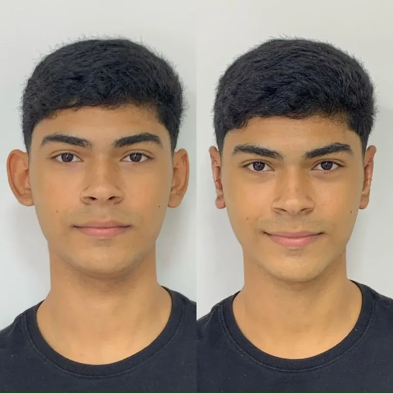 Otomodelação antes e depois em homem: orelha de abano projetada antes e orelha alinhada à cabeça depois do procedimento sem cirurgia na Luquini Clinic, Rio de Janeiro