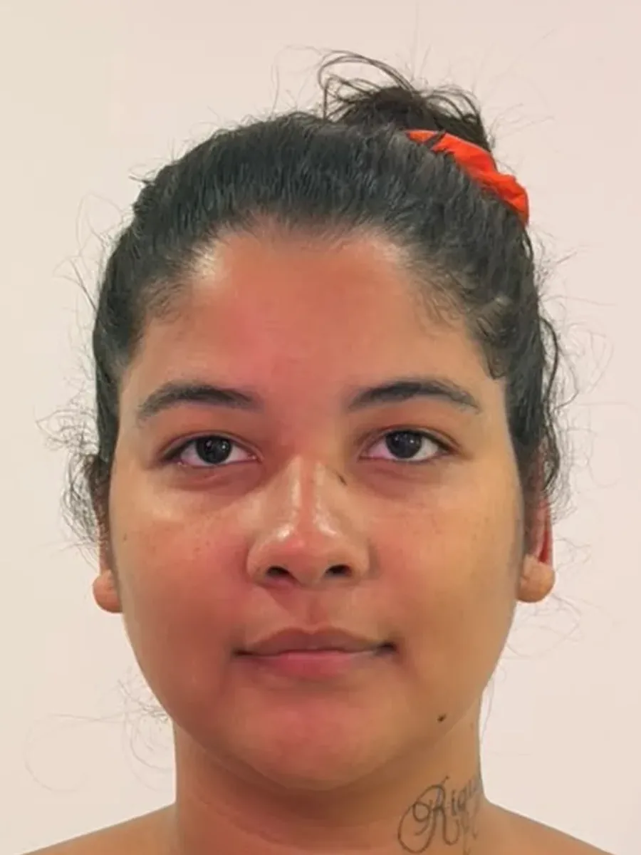 Depois da otomodelação sem cirurgia: orelhas alinhadas à cabeça em paciente feminina, vista frontal, Luquini Clinic no Rio de Janeiro